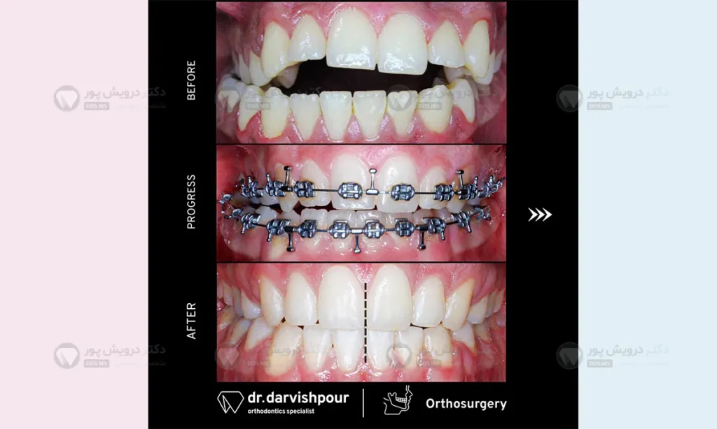 انحراف فک اسکلتی