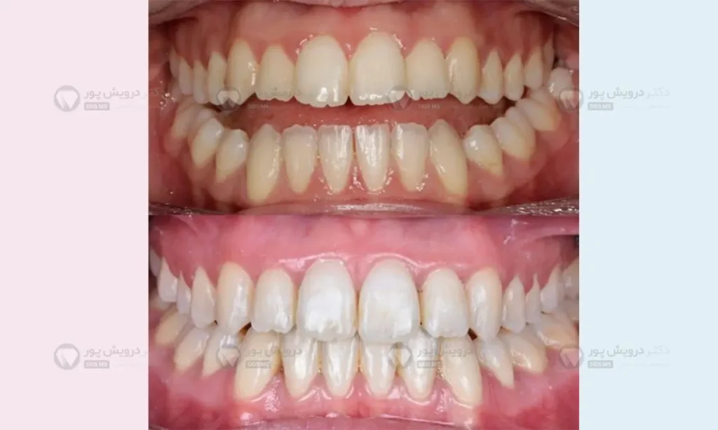 جراحی فک برای درمان اپن بایت یک طرفه