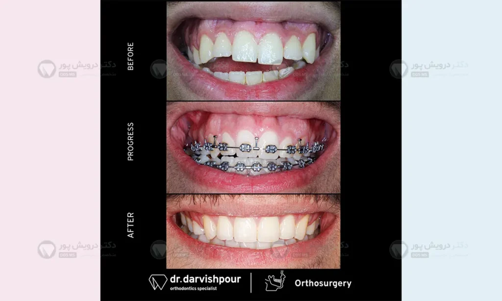 درمان لبخند لثه ای با ارتودنسی