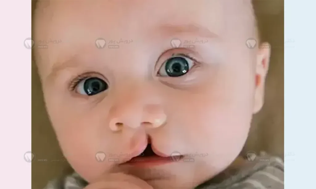 شکاف کام و لب