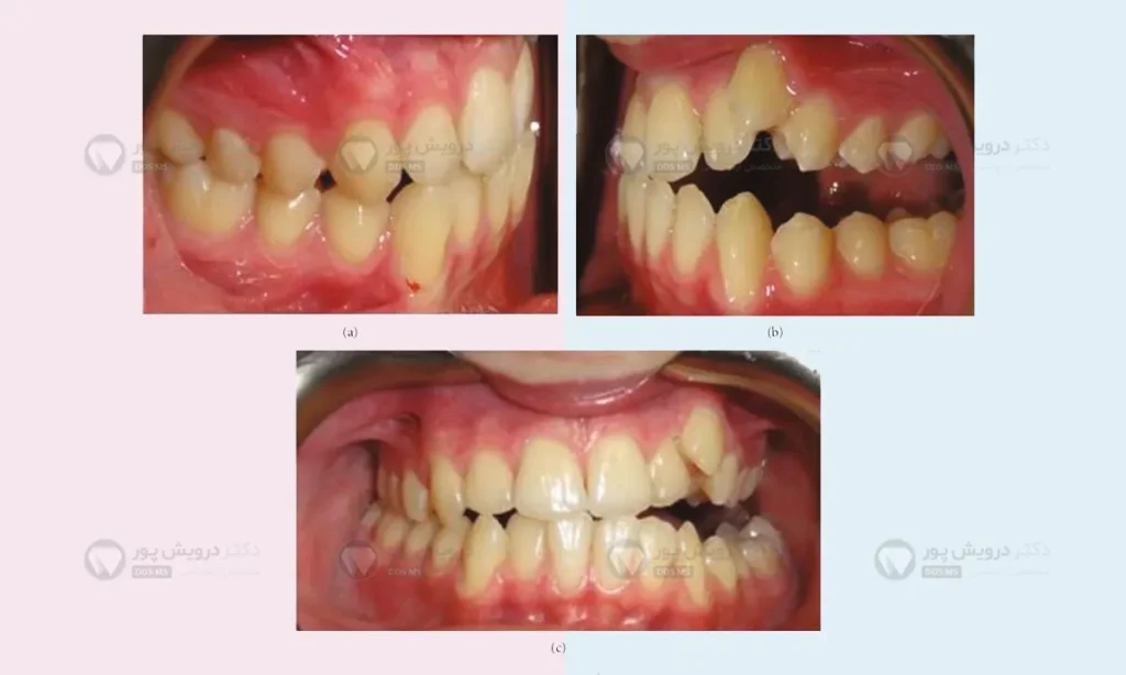 عکس اپن بایت یک طرفه