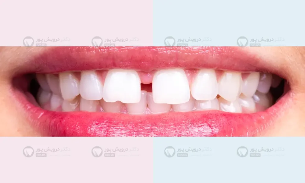 فاصله بین دندان ها