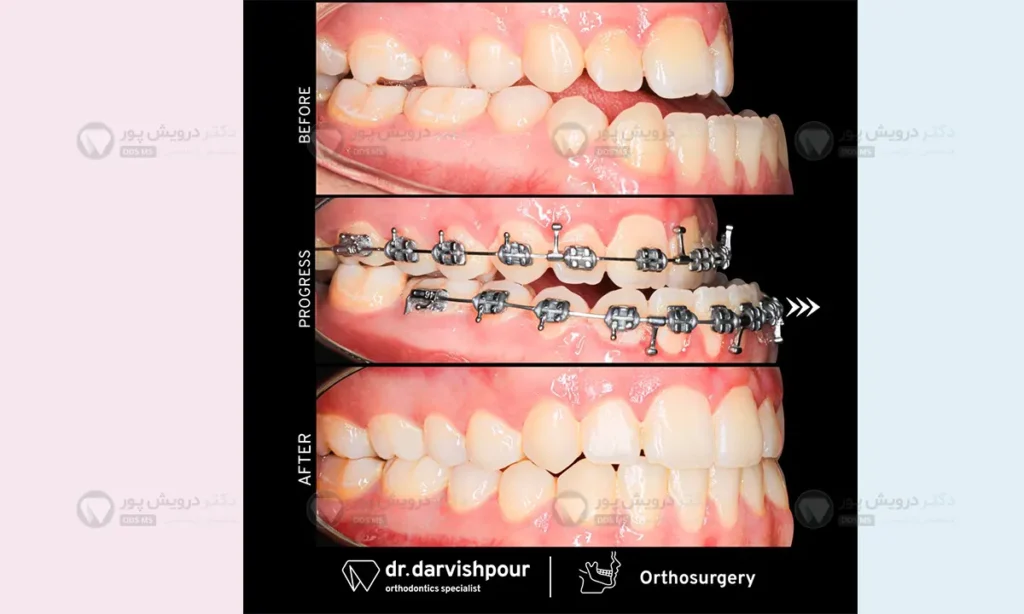 آندربایت چیست