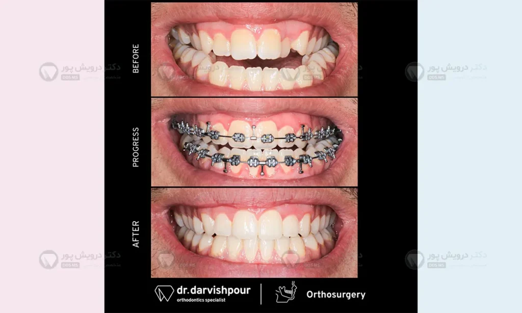 ارتودنسی دندان با جراحی
