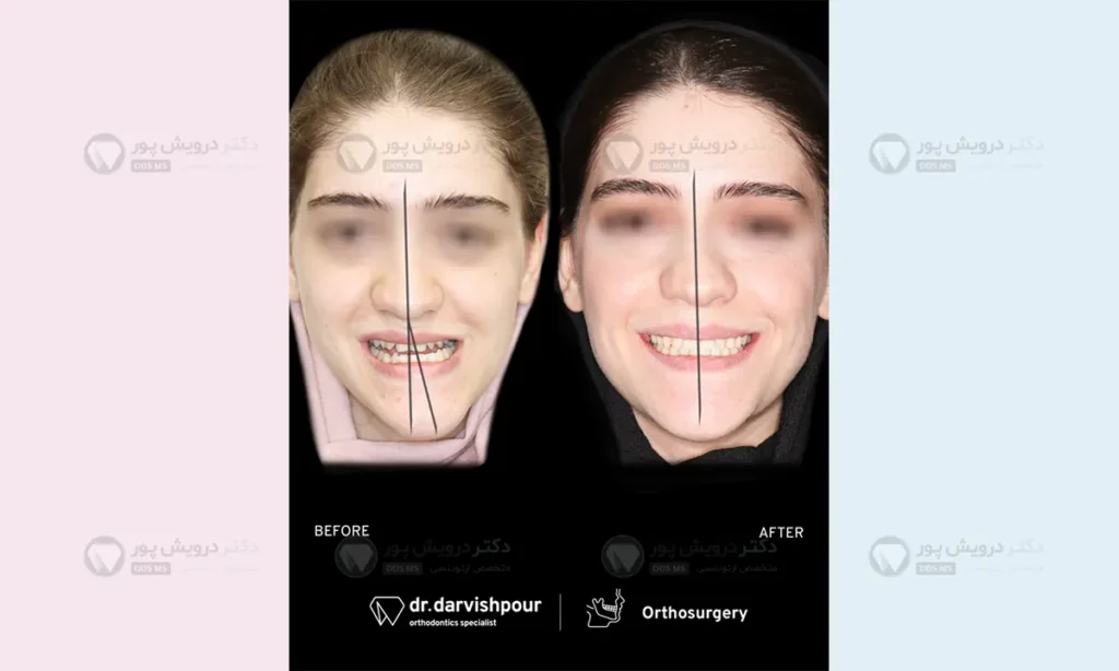 مفصل گیجگاهی فکی