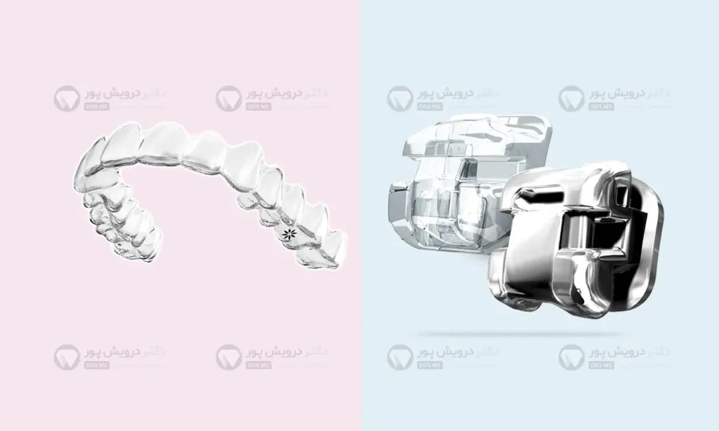 مقایسه الاینر شفاف و براکت دیمون