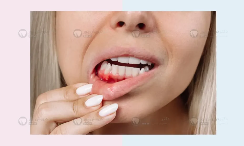 وضعیت لثه در بارداری