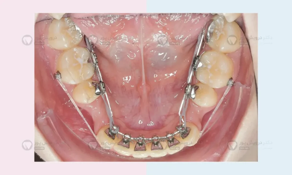 کشیدن دندان آسیا برای ارتودنسی
