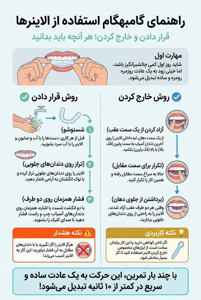 اینفوگرافی گذاشتن و برداشتن الاینر ارتودسی نامرئی