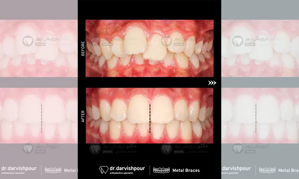 ارتودنسی بدون جراحی شاخص