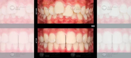 ارتودنسی بدون جراحی شاخص