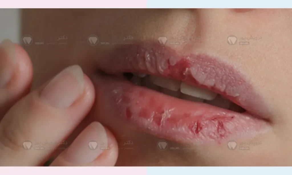 خشکی دهان در زمان استفاده از الاینرها