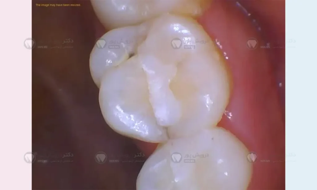 پوسیدگی دندان ج