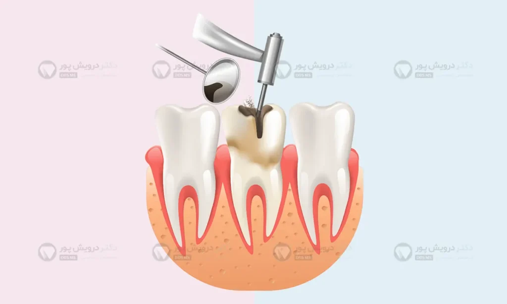 عصب کشی دندان حین درمان ارتودنسی