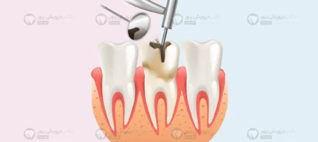 عصب کشی دندان حین درمان ارتودنسی