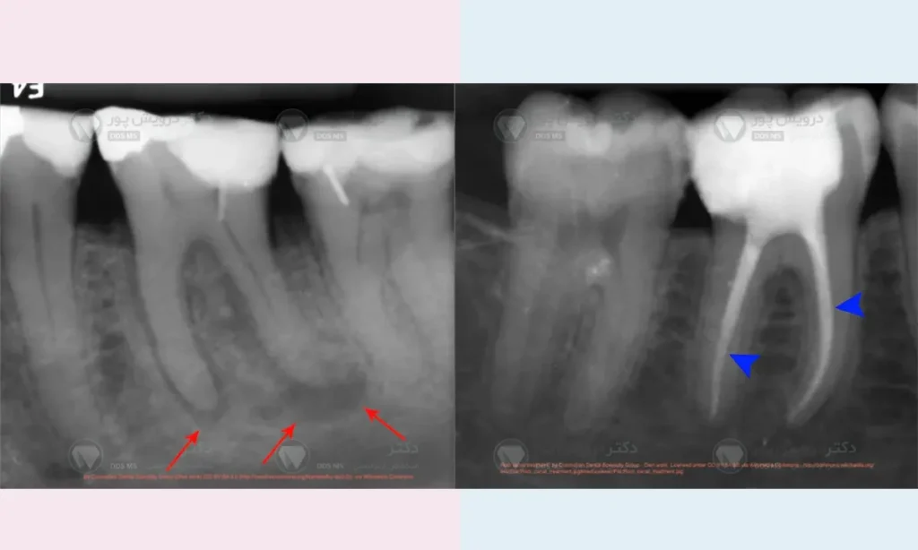 عصب کشی قبل از درمان ریشه