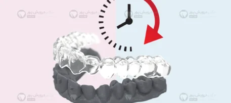 مدت زمان ارتودنسی نامرئی شاخص