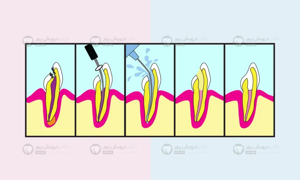 مراحل مختلف عصب کشی در  حین ارتودنسی