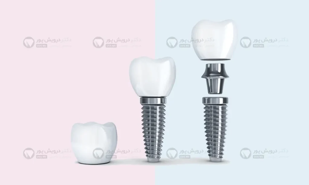 ایمپلنت دندان