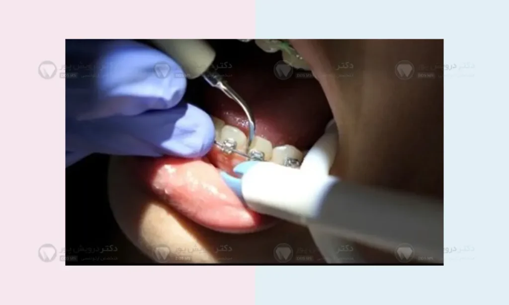 جرمگیری در زمان ارتودنسی دندان