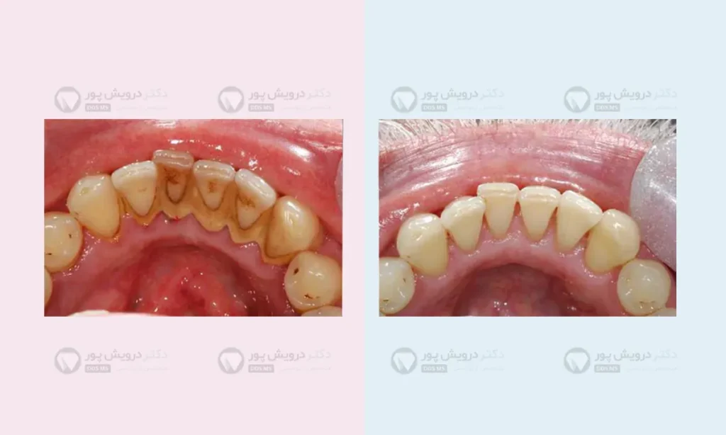 قبل و بعد از جرمگیری دندان