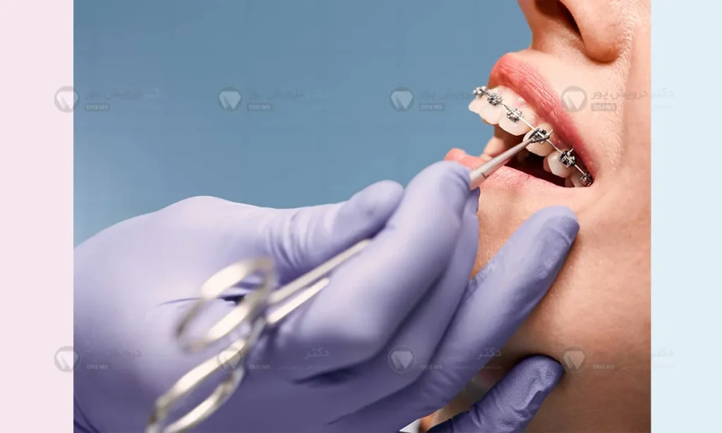 اتصال براکت ها به روی دندان ها