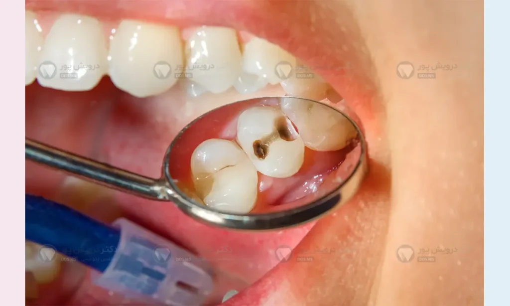 ترمیم دندان قبل از ارتودنسی شاخص