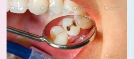 ترمیم دندان قبل از ارتودنسی شاخص