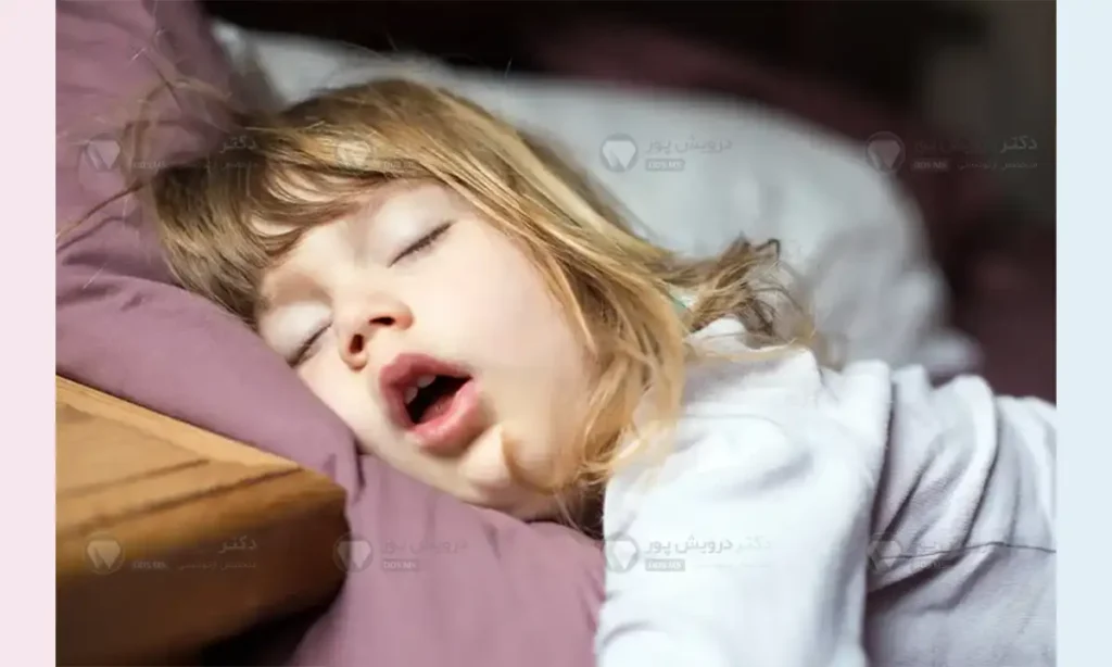 بهبود تنفس دهانی با ارتودنسی شاص