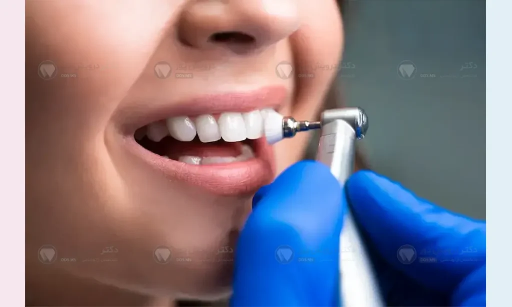 جرمگیری قبل از ارتودنسی دندان شاخص