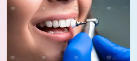 جرمگیری قبل از ارتودنسی دندان شاخص