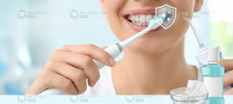 جلوگیری از زرد شدن دندان در طول ارتودنسی شاخص