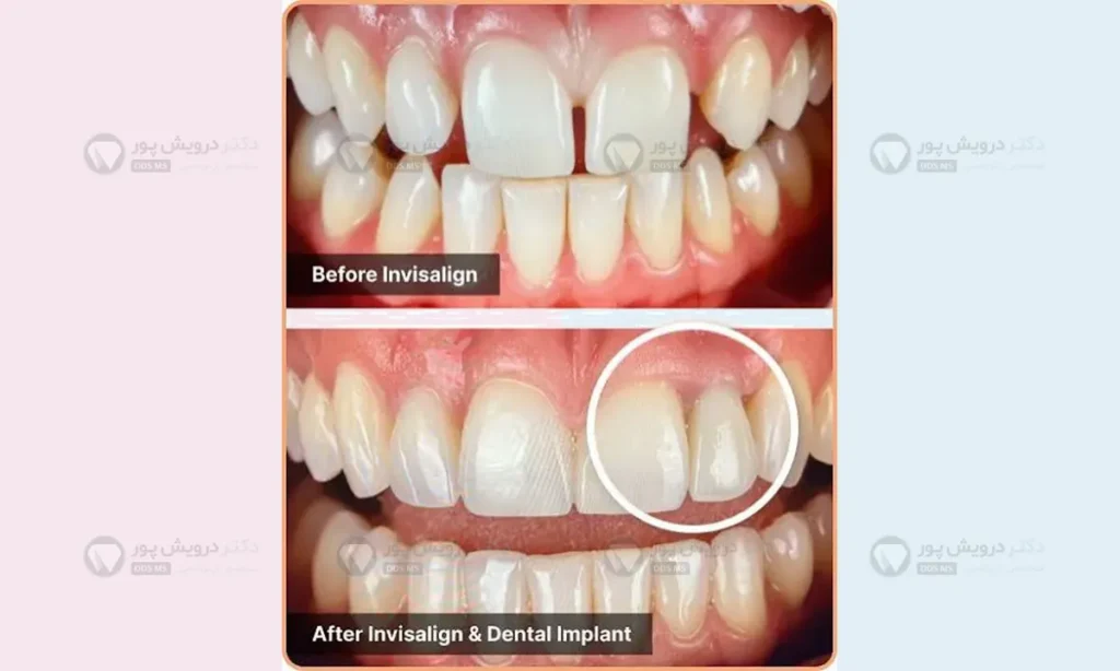 انجام همزمان ارتودنسی و کاشت ایمپلنت با هم