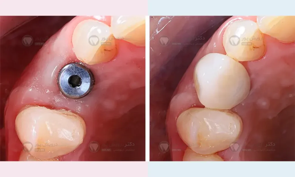 ایمپلنت دندان قبل و بعد