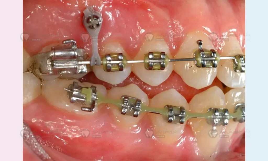 مینی اسکرو ارتودنسی