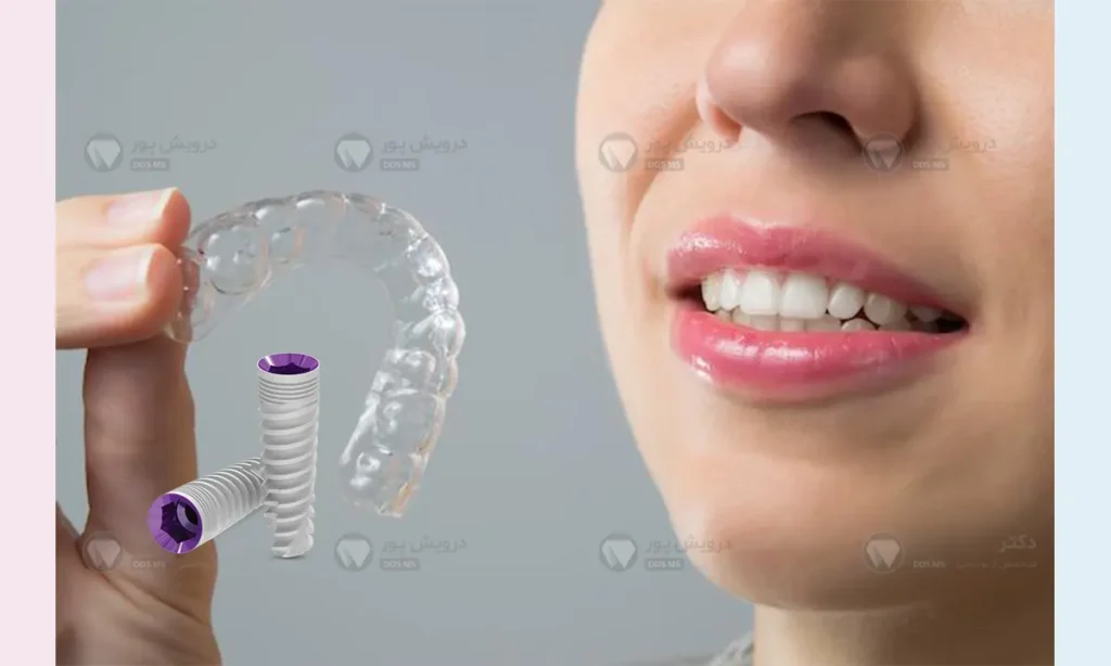 ایمپلنت بعد از ارتودنسی