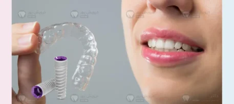 ایمپلنت بعد از ارتودنسی