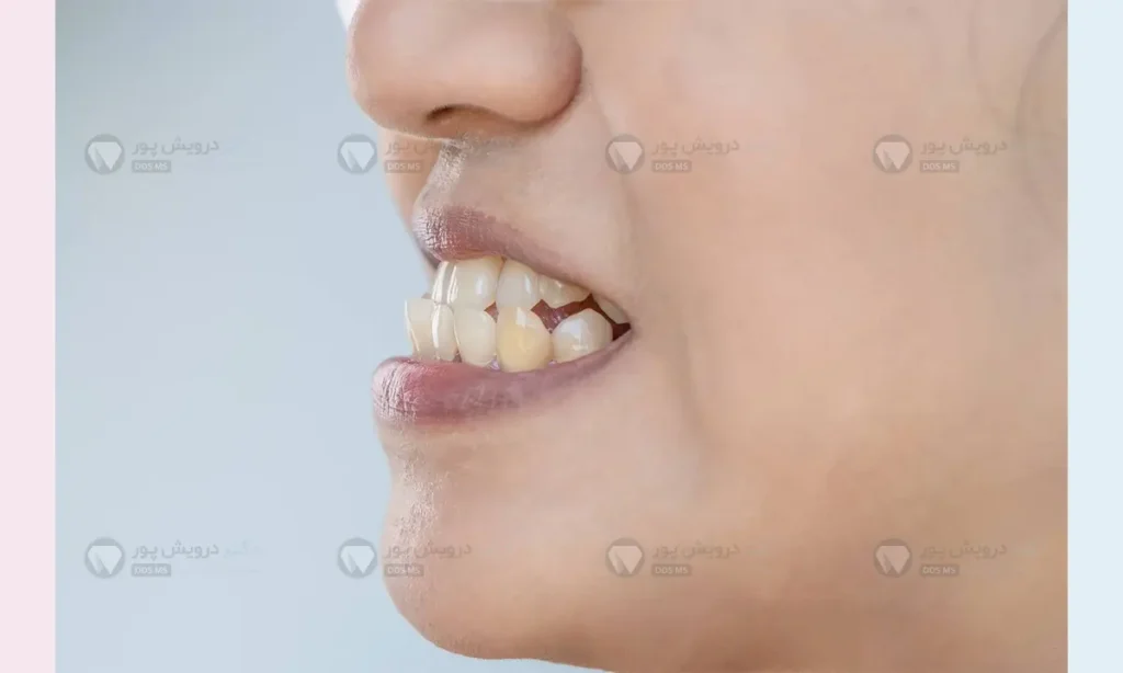 آندربایت از نیمرخ