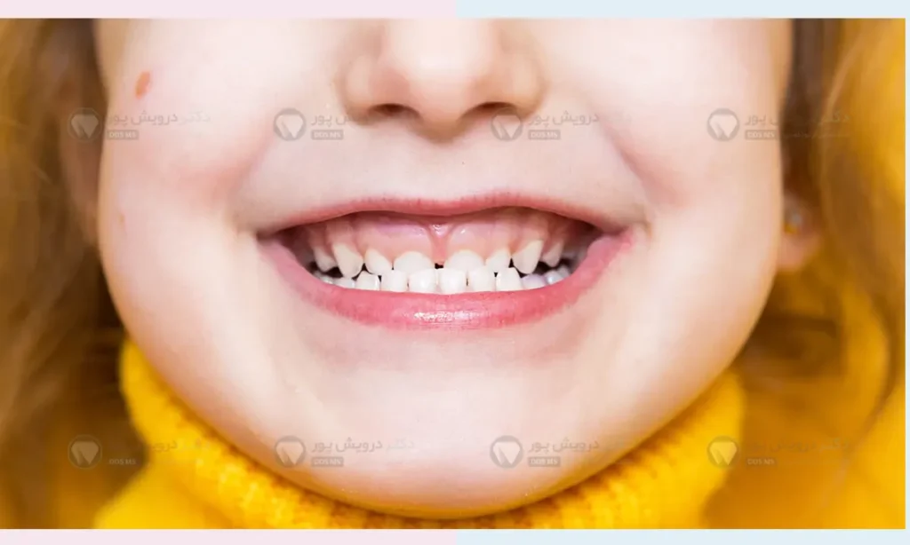 آندربایت کودکان