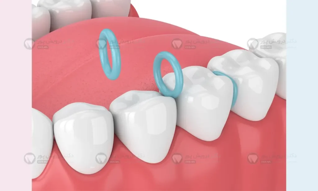 اسپیسر ارتودنسی