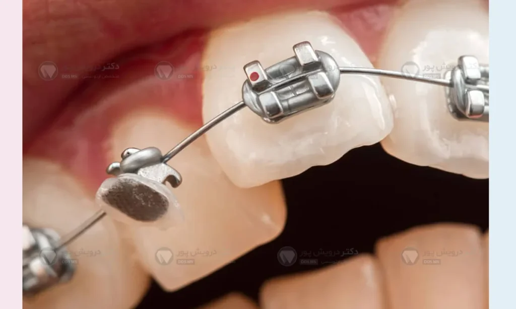 براکت ارتودنسی دندان