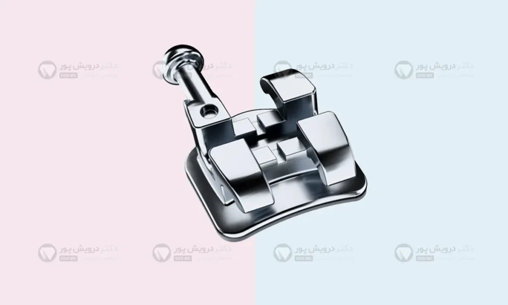 براکت فلزی دندان