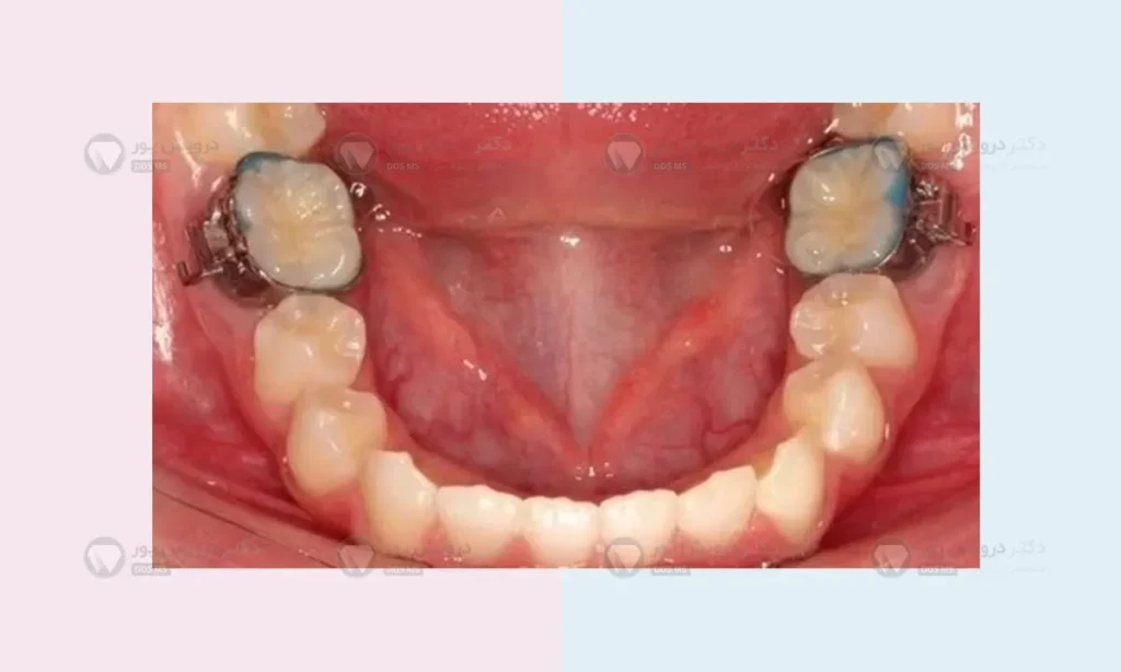 عکس واقعی بند ارتودنسی در فک پایین