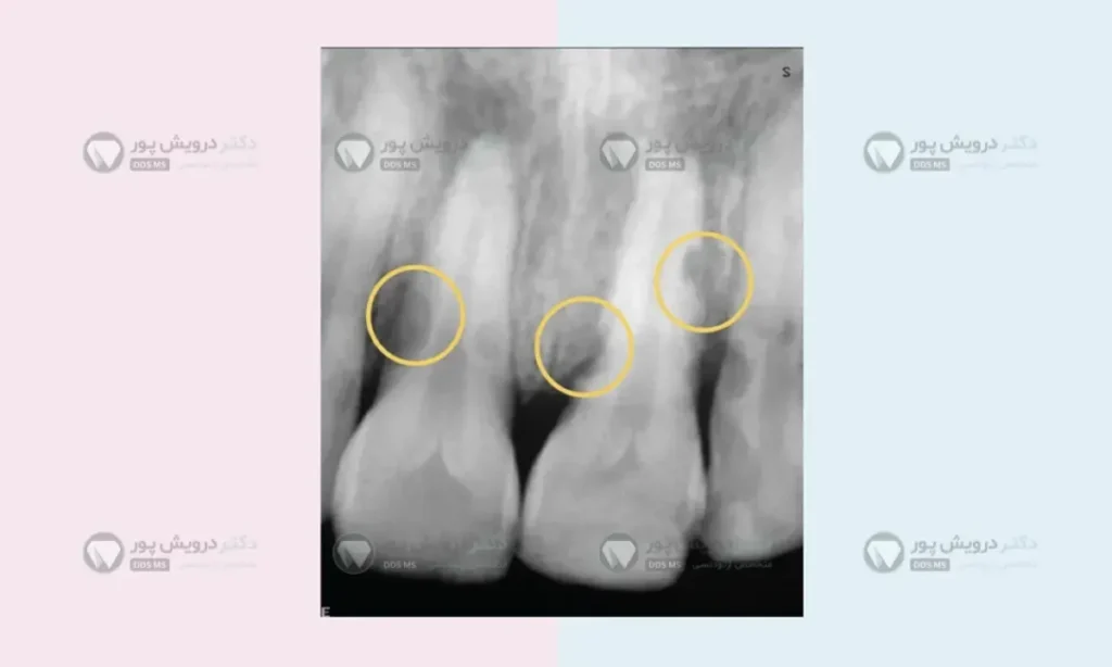 تحلیل ریشه دندان