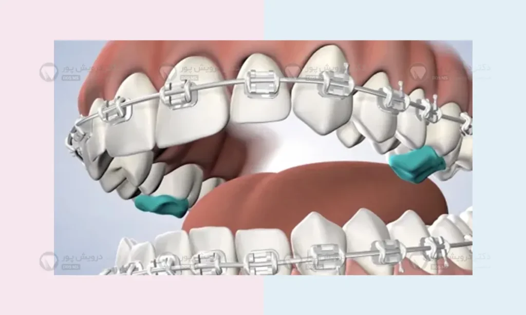 توربو بایت ارتودنسی