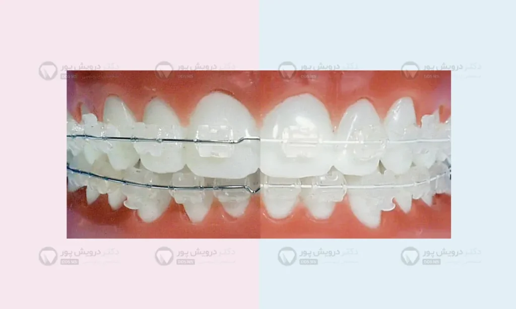 سیم قوس دار ارتودنسی روکش سفید