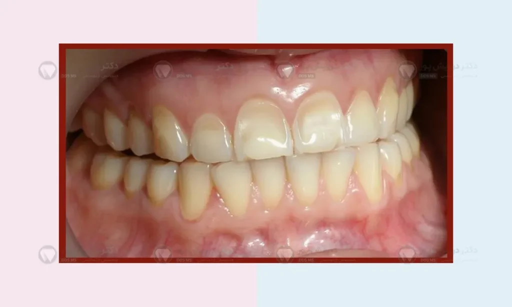 فرسایش مینای دندان