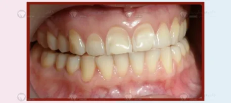 فرسایش مینای دندان