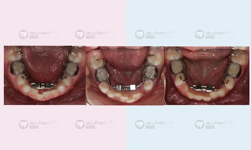 وسیع کننده فک پایین