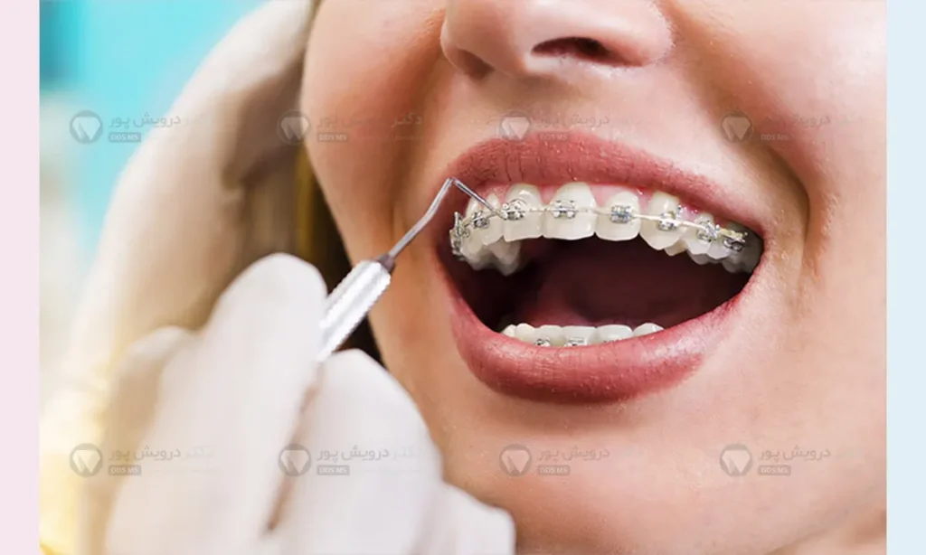 راحتی بیمار در طول ارتودنسی دیمون